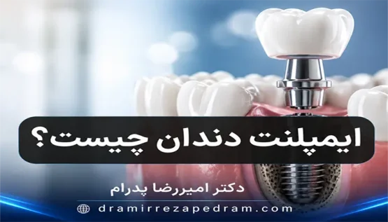 ایمپلنت دندان چیست؟