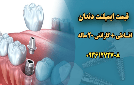 قیمت ایمپلنت دندان