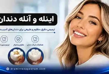 اینله و آنله دندان