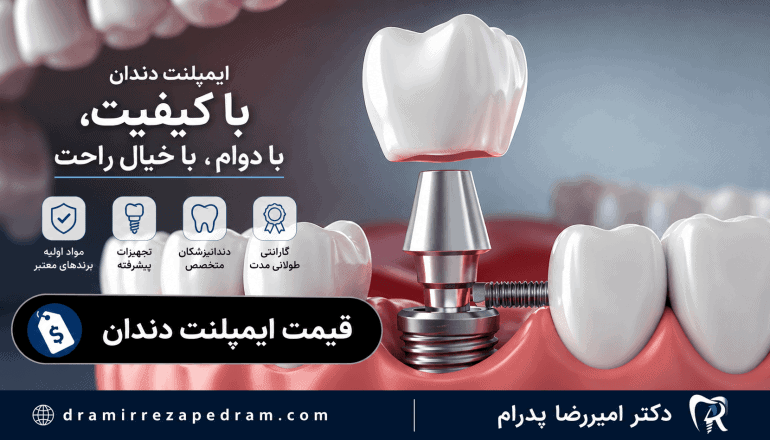 قیمت ایمپلنت دندان