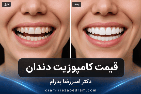 قیمت کامپوزیت دندان