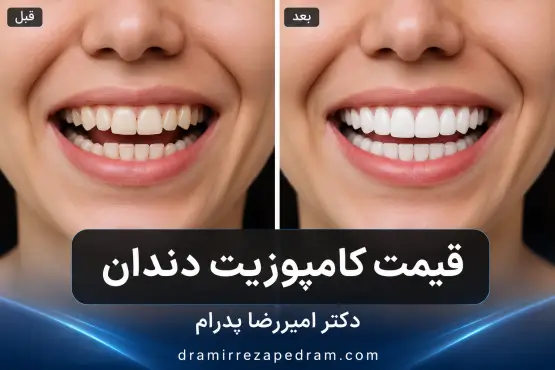 قیمت کامپوزیت دندان