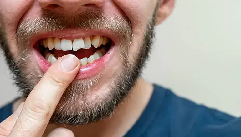 تروما دندان چگونه به وجود میآید