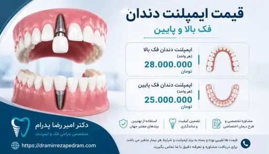 قیمت ایمپلنت فک بالا و پایین