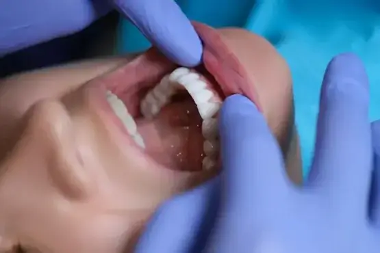 لمینت دندان سرامیکی
