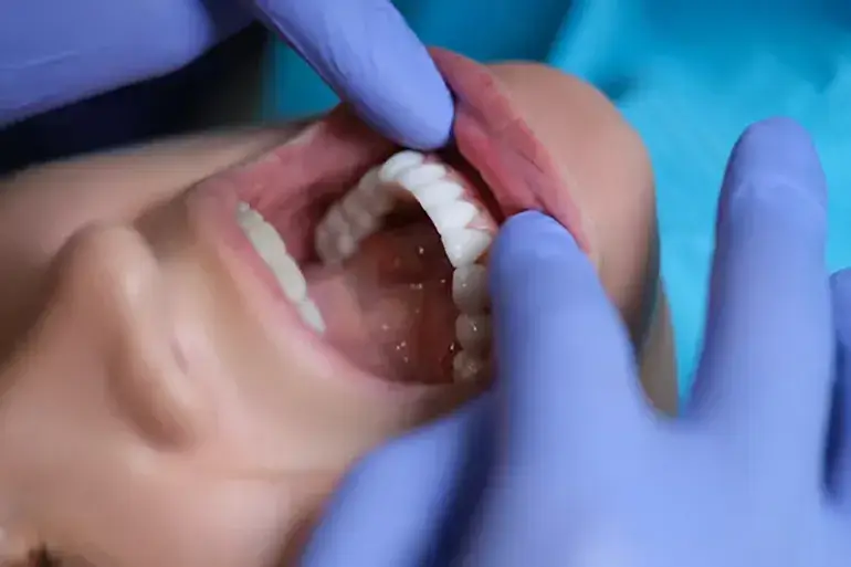 لمینت دندان سرامیکی