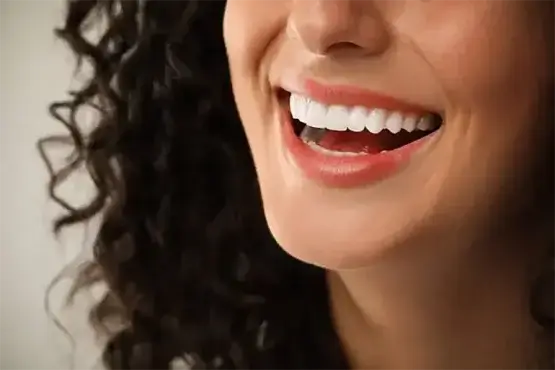 مزایای بلیچینگ دندان دو
