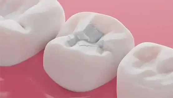 کامپوزیت برای دندان خرگوشی