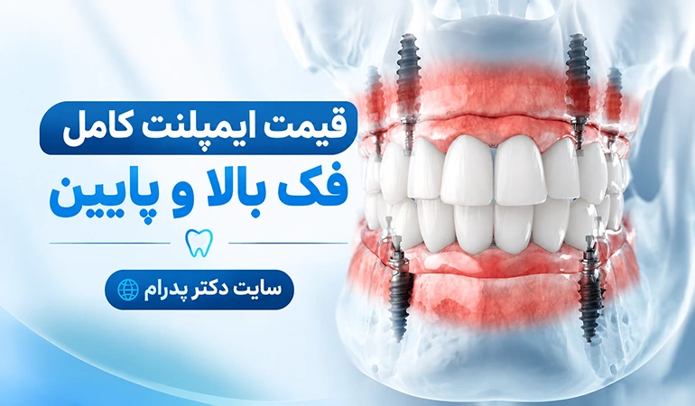 قیمت ایمپلنت کامل فک بالا و پایین