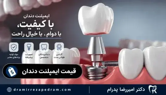 قیمت ایمپلنت دندان