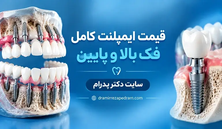 قیمت ایمپلنت کامل فک بالا و پایین